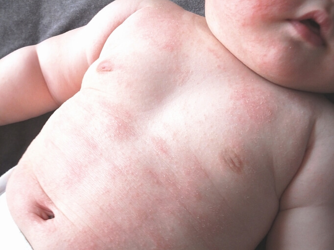 赤ちゃんのブツブツ「乳児湿疹」とは